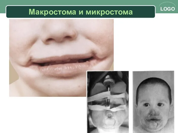 Макростома и микростома