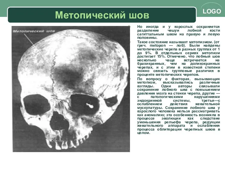 Метопический шов Но иногда и у взрослых сохраняется разделение чешуи лобной