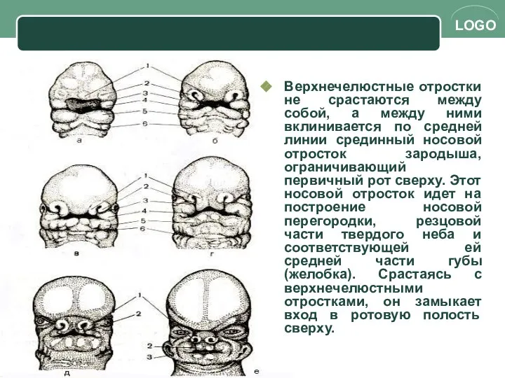 Верхнечелюстные отростки не срастаются между собой, а между ними вклинивается по