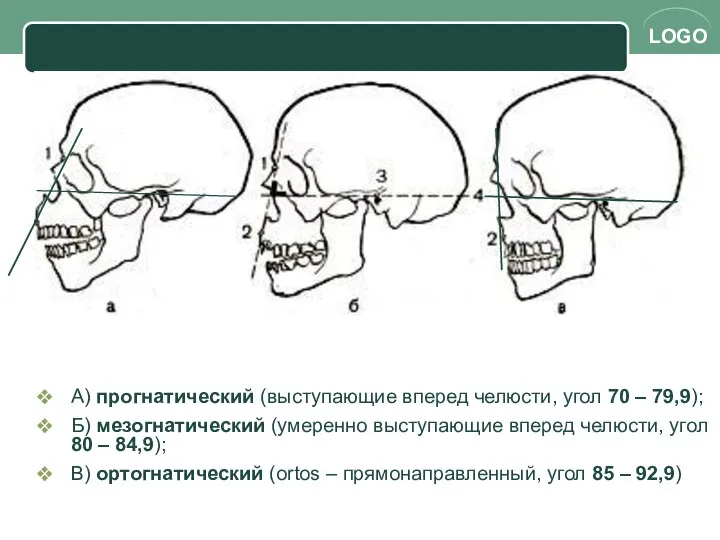 А) прогнатический (выступающие вперед челюсти, угол 70 – 79,9); Б) мезогнатический