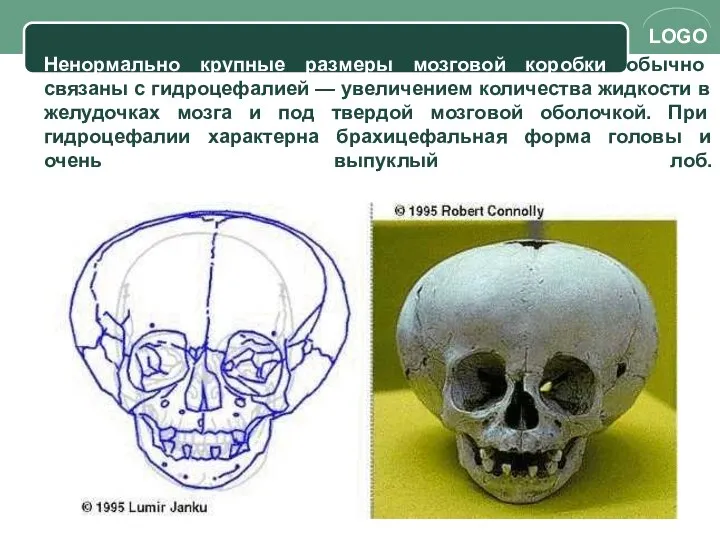 Ненормально крупные размеры мозговой коробки обычно связаны с гидроцефалией — увеличением