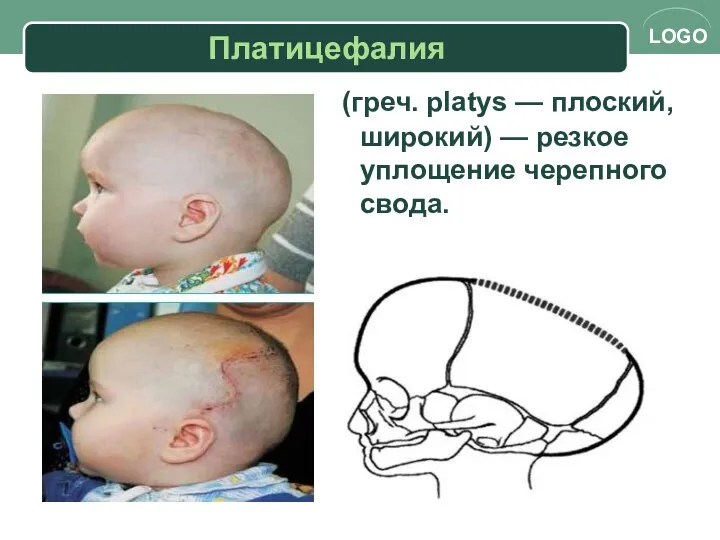 Платицефалия (греч. platys — плоский, широкий) — резкое уплощение черепного свода.