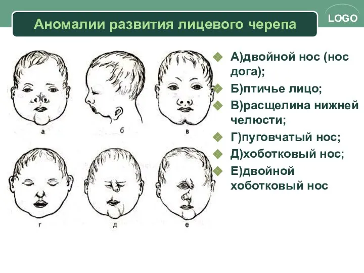 Аномалии развития лицевого черепа А)двойной нос (нос дога); Б)птичье лицо; В)расщелина