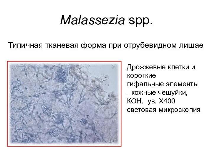 Дрожжевые клетки и короткие гифальные элементы - кожные чешуйки, КОН, ув.