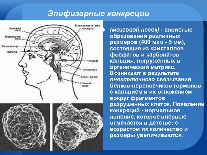 Эпифизарные конкреции (мозговой песок) - слоистые образования различных размеров (400 мкм