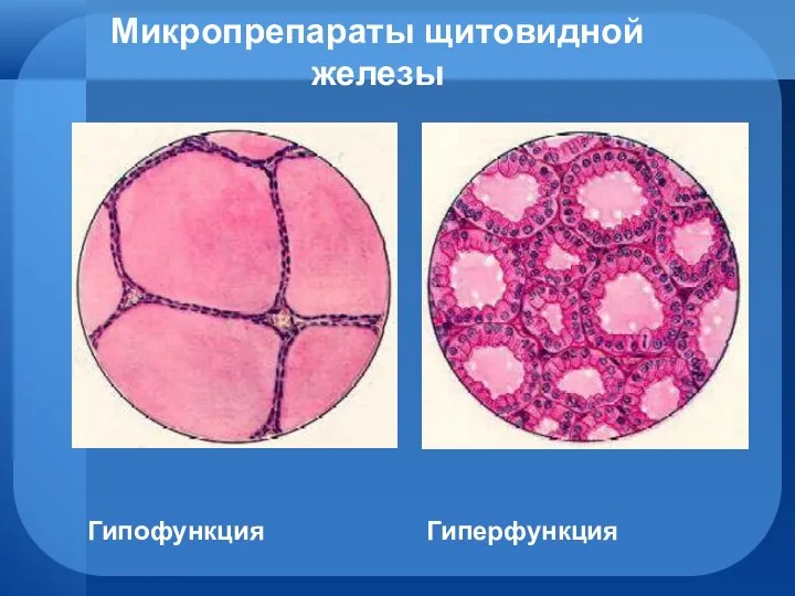 Микропрепараты щитовидной железы Гипофункция Гиперфункция