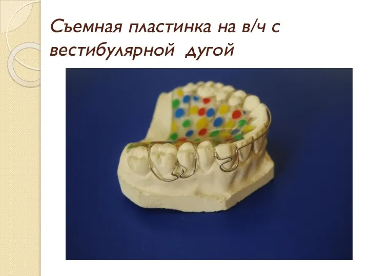 Съемная пластинка на в/ч с вестибулярной дугой