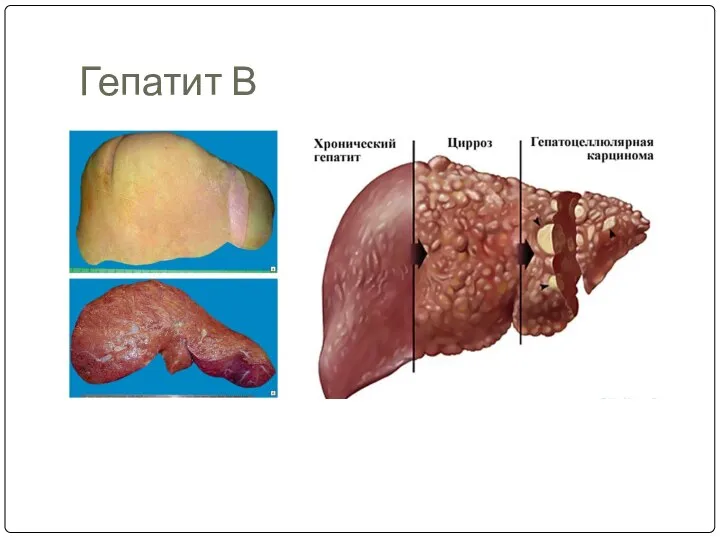 Гепатит В