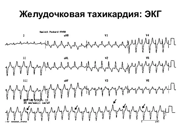 Желудочковая тахикардия: ЭКГ