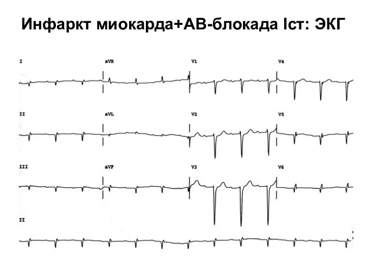 Инфаркт миокарда+АВ-блокада Iст: ЭКГ