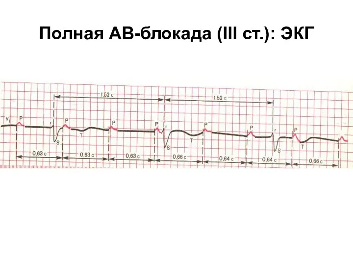 Полная АВ-блокада (III ст.): ЭКГ