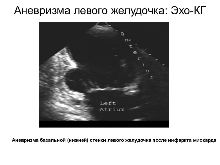 Аневризма левого желудочка: Эхо-КГ Аневризма базальной (нижней) стенки левого желудочка после инфаркта миокарда