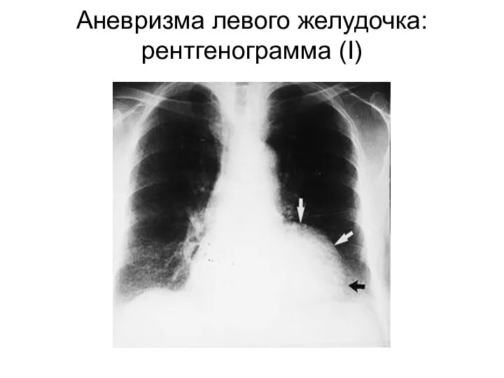 Аневризма левого желудочка: рентгенограмма (I)