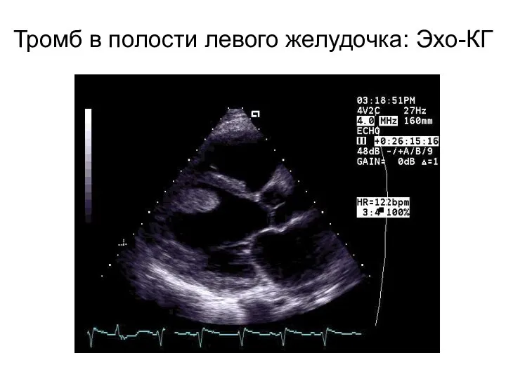 Тромб в полости левого желудочка: Эхо-КГ