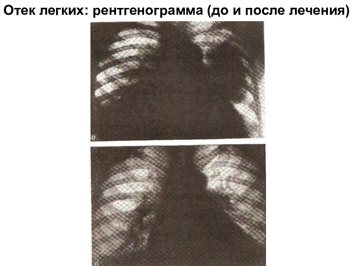 Отек легких: рентгенограмма (до и после лечения)