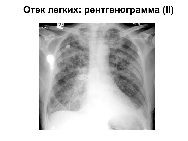 Отек легких: рентгенограмма (II)