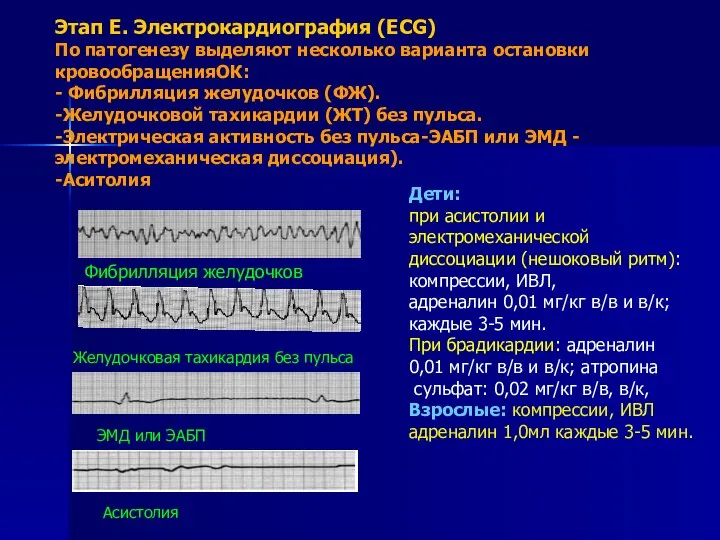 Этап E. Электрокардиография (ECG) По патогенезу выделяют несколько варианта остановки кровообращенияОК: