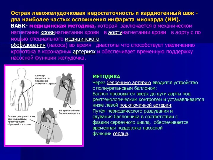 Острая левожелудочковая недостаточность и кардиогенный шок - два наиболее частых осложнения