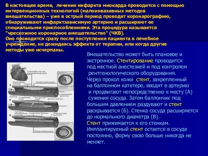 В настоящее время, лечение инфаркта миокарда проводится с помощью интервенционных технологий