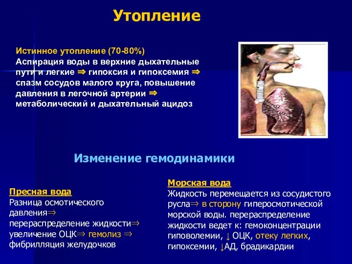 Утопление Истинное утопление (70-80%) Аспирация воды в верхние дыхательные пути и