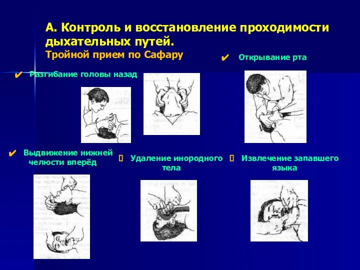 А. Контроль и восстановление проходимости дыхательных путей. Тройной прием по Сафару