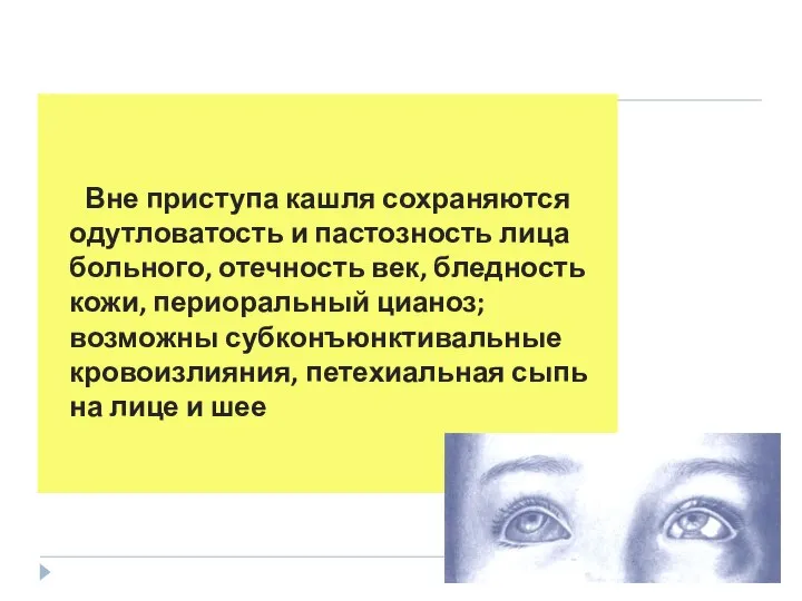 Вне приступа кашля сохраняются одутловатость и пастозность лица больного, отечность век,