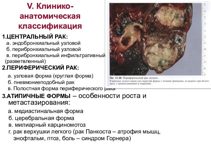 V. Клинико-анатомическая классификация 1.ЦЕНТРАЛЬНЫЙ РАК: а. эндобронхиальный узловой б. перибронхиальный узловой