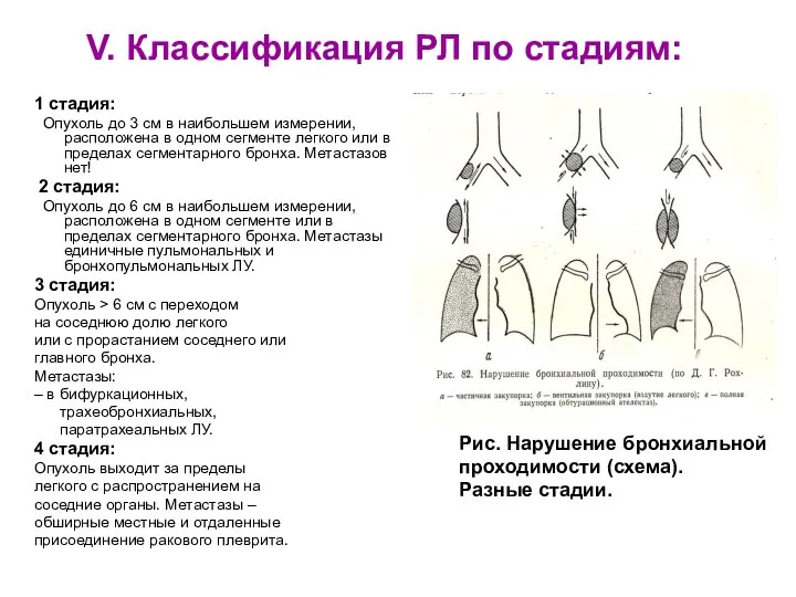 V. Классификация РЛ по стадиям: 1 стадия: Опухоль до 3 см