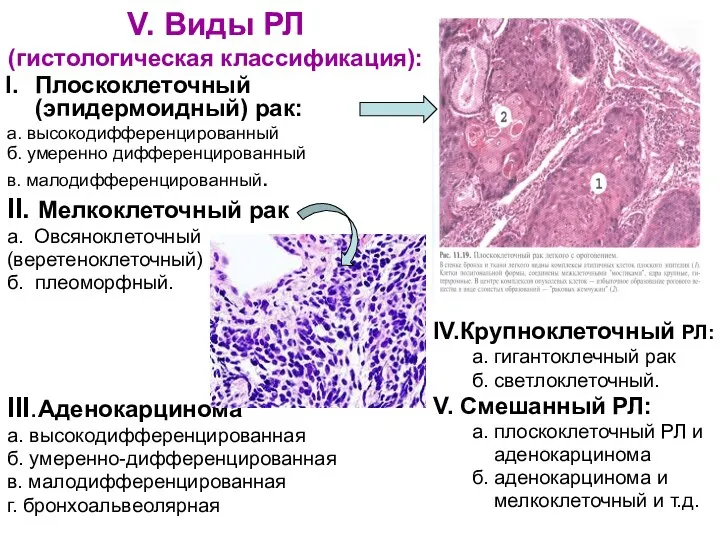 V. Виды РЛ (гистологическая классификация): Плоскоклеточный (эпидермоидный) рак: а. высокодифференцированный б.