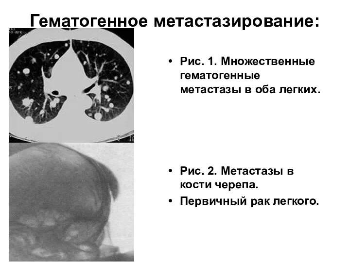 Гематогенное метастазирование: Рис. 1. Множественные гематогенные метастазы в оба легких. Рис.