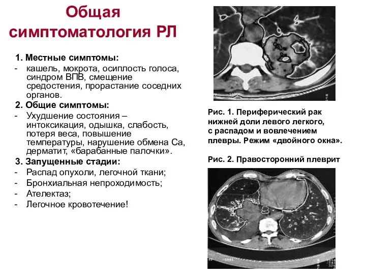 Общая симптоматология РЛ 1. Местные симптомы: кашель, мокрота, осиплость голоса, синдром