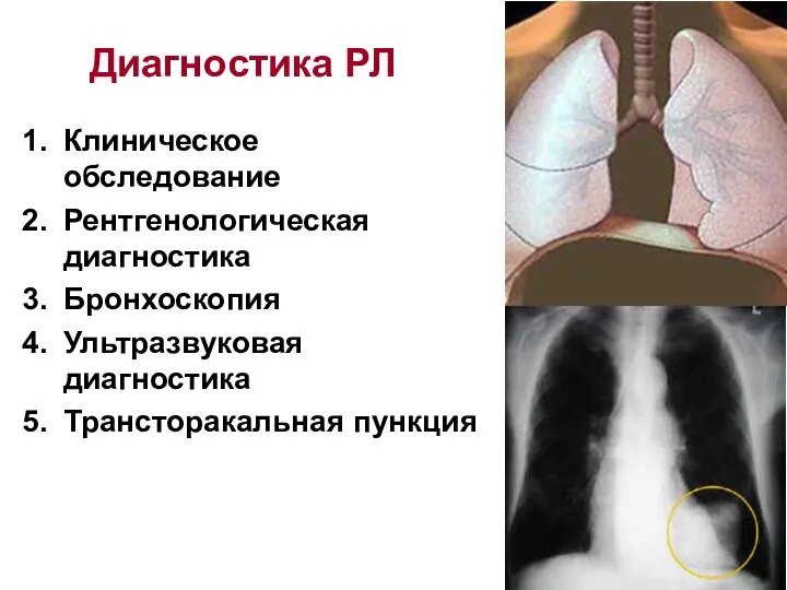 Диагностика РЛ Клиническое обследование Рентгенологическая диагностика Бронхоскопия Ультразвуковая диагностика Трансторакальная пункция