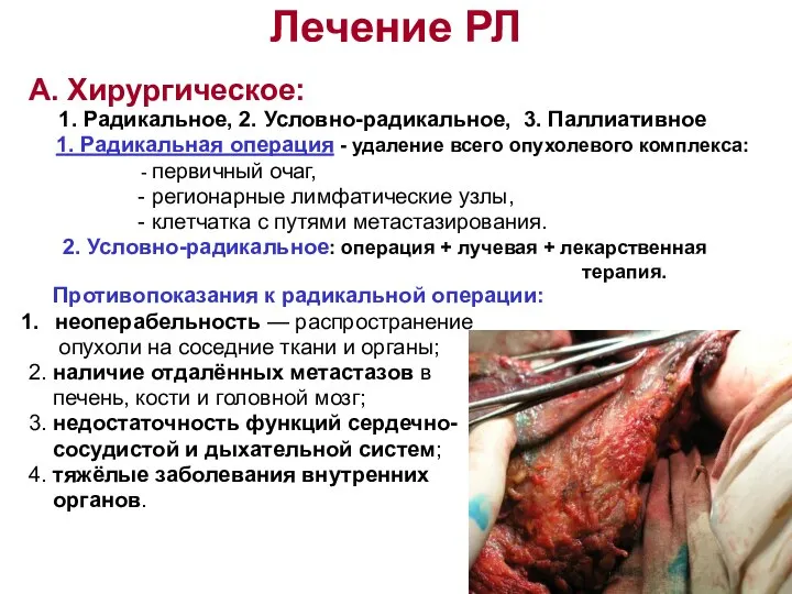 Лечение РЛ А. Хирургическое: 1. Радикальное, 2. Условно-радикальное, 3. Паллиативное 1.