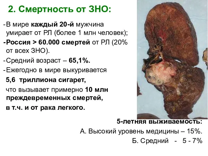 2. Смертность от ЗНО: В мире каждый 20-й мужчина умирает от