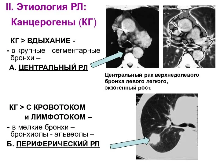 II. Этиология РЛ: Канцерогены (КГ) КГ > ВДЫХАНИЕ - - в