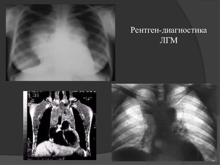 Рентген-диагностика ЛГМ