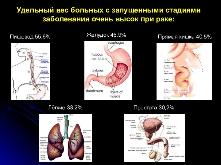 Удельный вес больных с запущенными стадиями заболевания очень высок при раке: