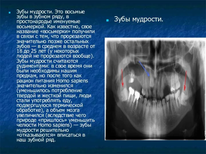 Зубы мудрости. Это восьмые зубы в зубном ряду, в простонародье именуемые