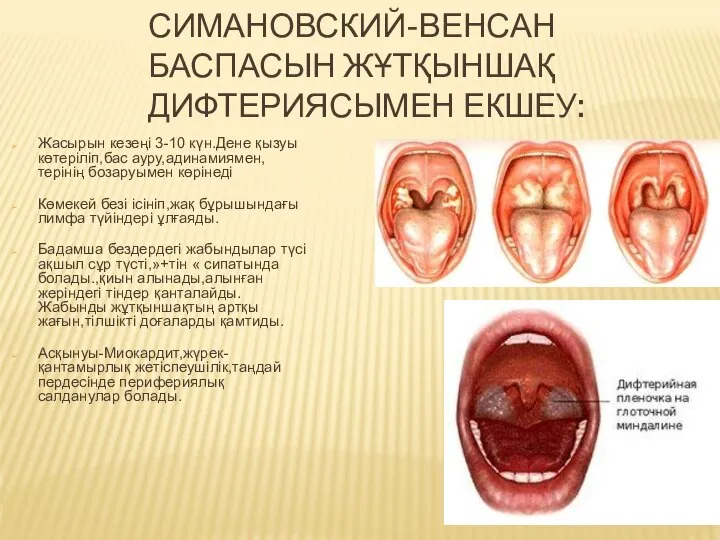 СИМАНОВСКИЙ-ВЕНСАН БАСПАСЫН ЖҰТҚЫНШАҚ ДИФТЕРИЯСЫМЕН ЕКШЕУ: Жасырын кезеңі 3-10 күн.Дене қызуы көтеріліп,бас