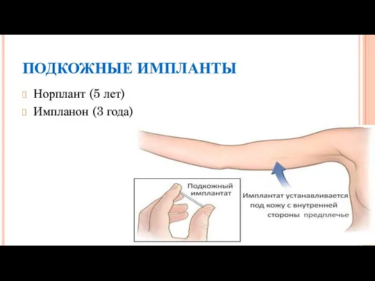 ПОДКОЖНЫЕ ИМПЛАНТЫ Норплант (5 лет) Импланон (3 года)