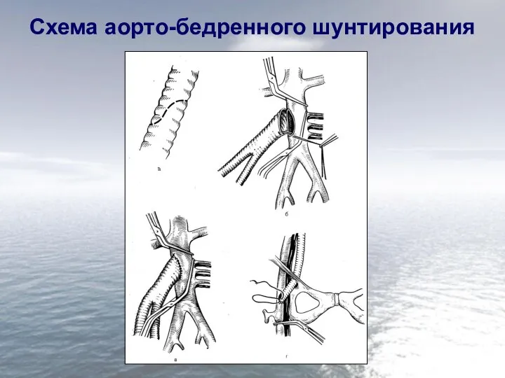 Схема аорто-бедренного шунтирования