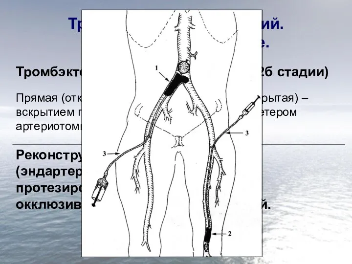 Тромбоз. Эмболия артерий. Хирургическое лечение.