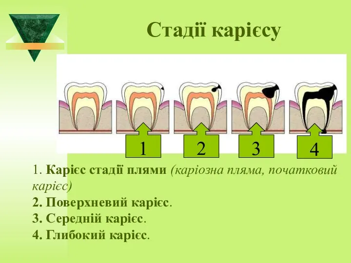 Стадії карієсу 1. Карієс стадії плями (каріозна пляма, початковий карієс) 2.