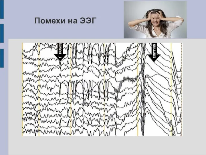 Помехи на ЭЭГ