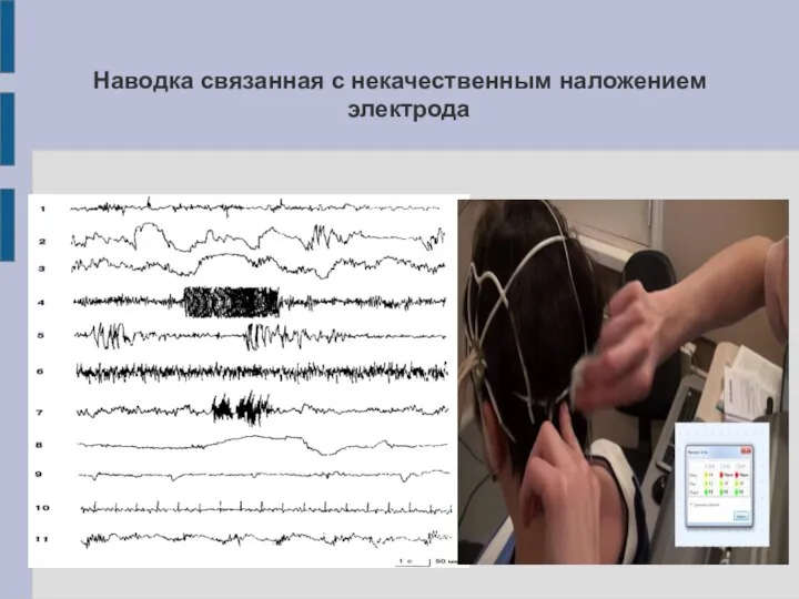 Наводка связанная с некачественным наложением электрода