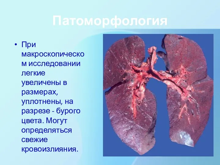 Патоморфология При макроскопическом исследовании легкие увеличены в размерах, уплотнены, на разрезе