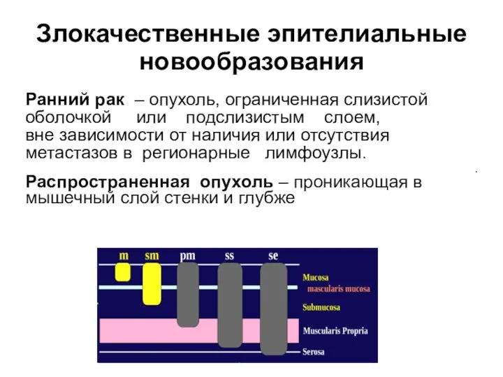 Ранний рак – опухоль, ограниченная слизистой оболочкой или подслизистым слоем, вне