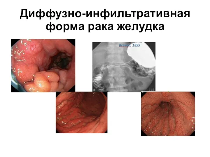 Диффузно-инфильтративная форма рака желудка