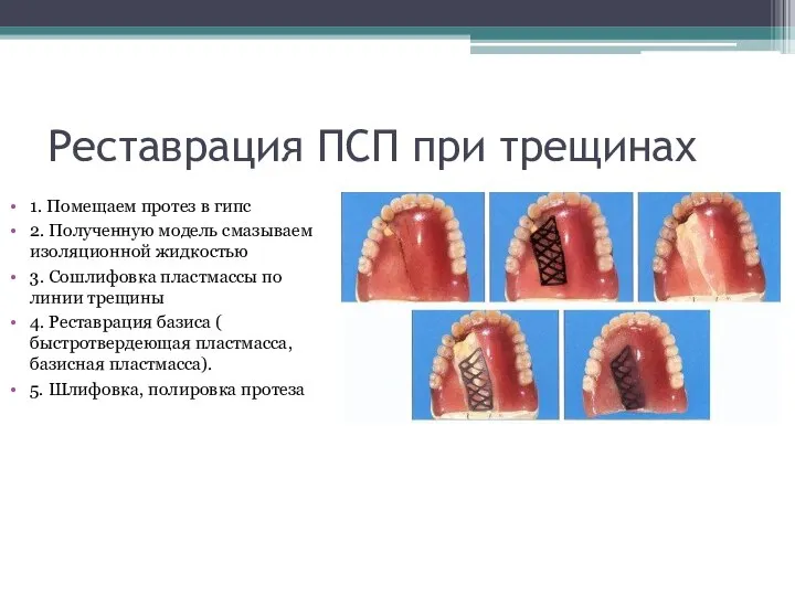 Реставрация ПСП при трещинах 1. Помещаем протез в гипс 2. Полученную