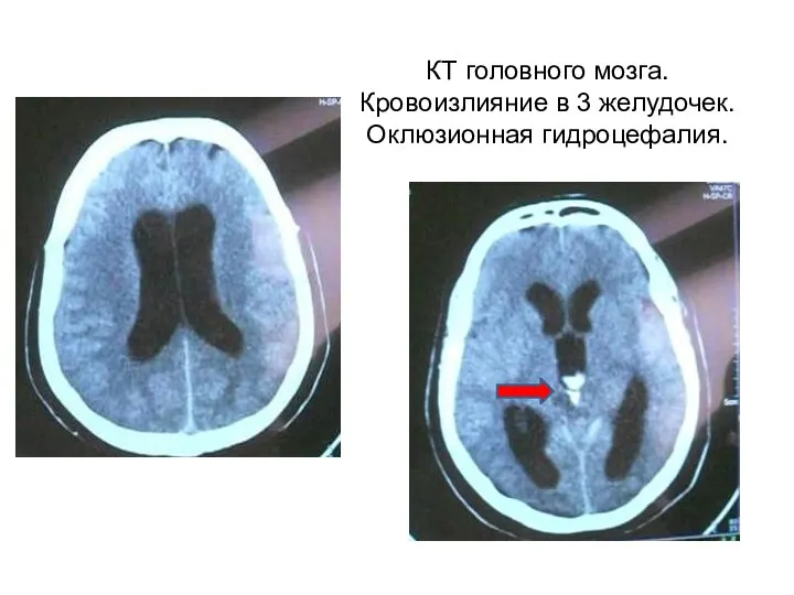 КТ головного мозга. Кровоизлияние в 3 желудочек. Оклюзионная гидроцефалия.